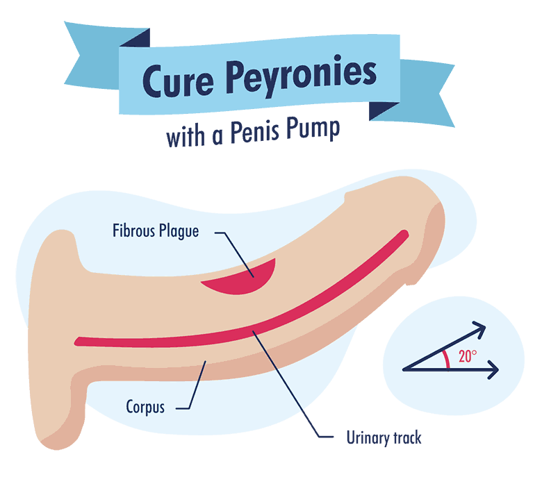 Cure Peyronies Disease with a Penis Pump